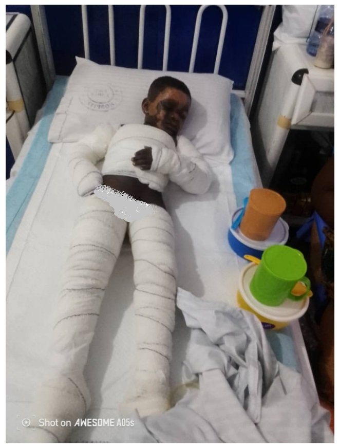 Mother and children suffer severe burns, appeal for support for life-saving treatment
